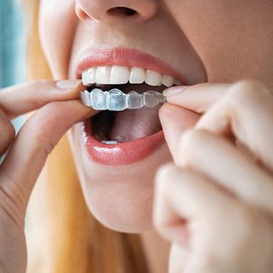 Woman about to put aligners on teeth