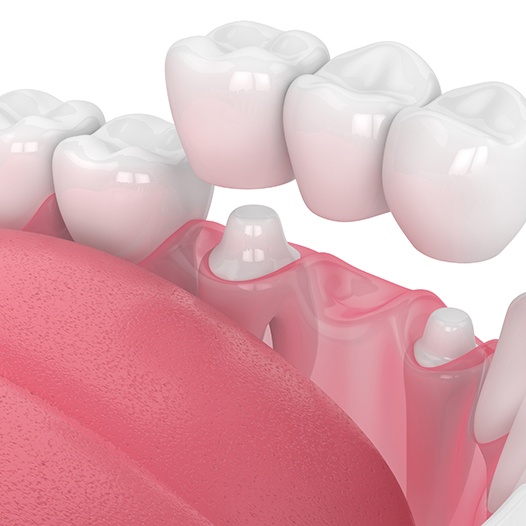 Illustration of dental bridge in Mineola, NY being placed on teeth