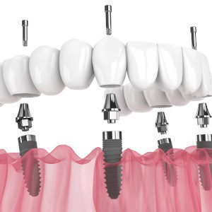 A picture of implant dentures