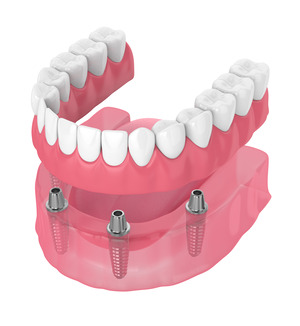 Dentures being attached to two dental implants